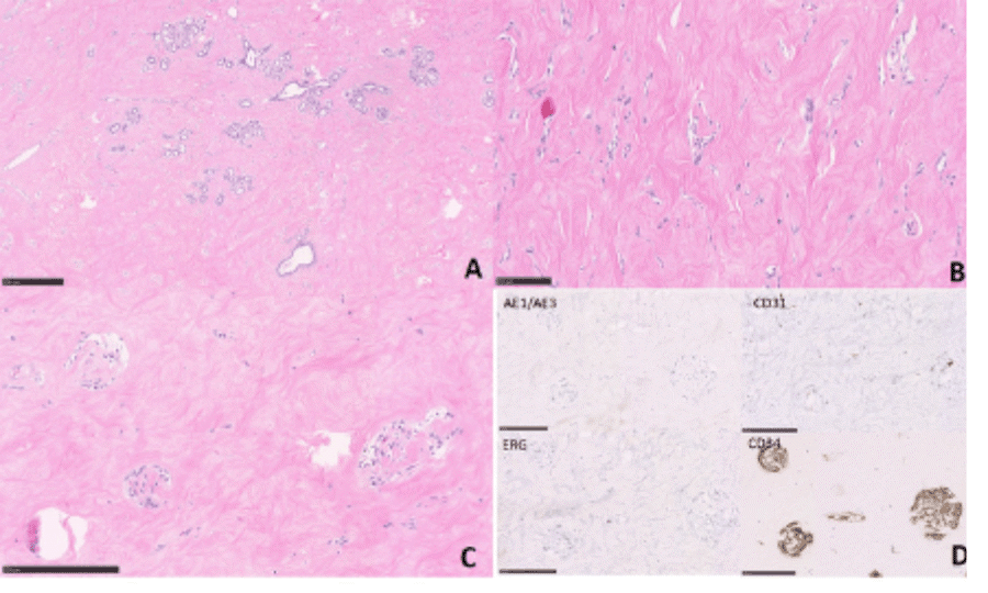 A) Benign ductal epithelium in keloid-like stroma; B) slit-like anastomosing spaces classically indicative of PASH; C) scattered glomeruloid formations; D) CD34+/CD31-staining consistent with benign myofibroblast proliferation