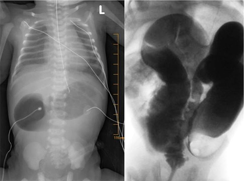 Figure 1a and 1b. Double bubble on KUB and Transition point on contrast enema.