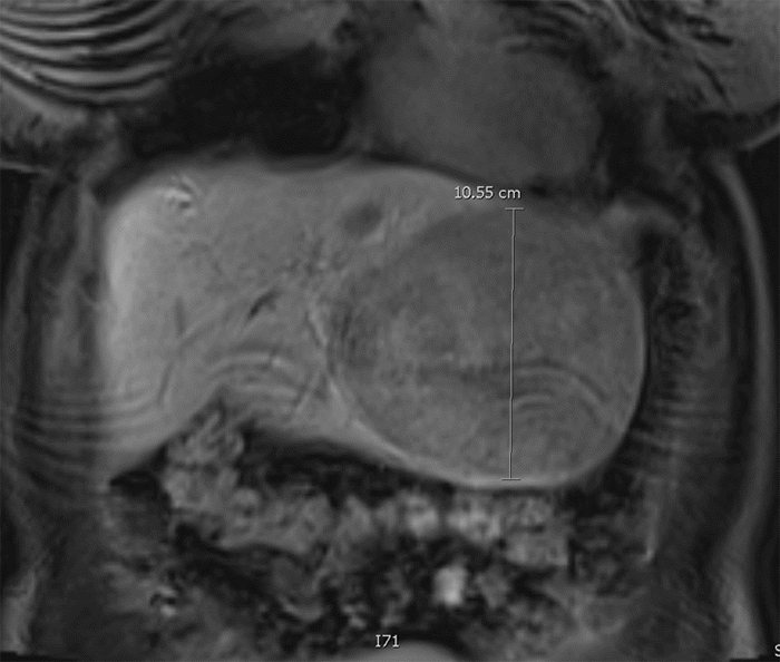 (B) coronal gadoxetate-enhanced MRI liver image demonstrating a 10.6 × 12.1 × 6.8 cm left lobe segment II-IV lesion exhibiting heterogeneous enhancement that persists into the hepatobiliary phase, along with a T2-hypointense central scar. Additionally, two areas consistent with focal nodular hyperplasia are identified in segments IVb and VI, along with three small (~1 cm) lesions likely consistent with hepatic adenomas in segments VI and VII.