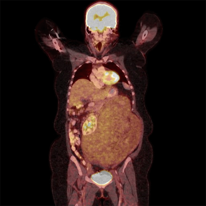 Large, predominantly retroperitoneal mass with heterogeneous FDG activity. The mass extends from the left upper quadrant to the superior pelvis, exhibiting concerning features for malignancy/sarcoma