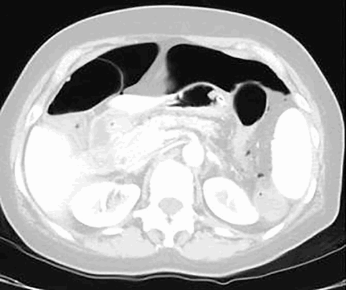 Figure 2. CT scan of abdomen done in ED on admission, lung window.