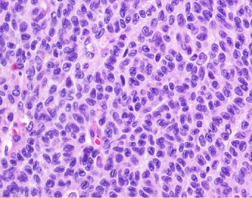 Note cells with indistinct to delicate borders without gland formation arranged in a trabecular pattern with moderately atypical nuclei with nuclear grooves and small nucleoli