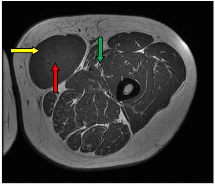 Figure 1. B: Axial MRI view of the tumor. Yellow arrow marks tumor margin, green arrow marks neurovascular bundle approximately 1.5-2 cm from the tumor margin, red arrow marks the great saphenous vein encased in tumor.
