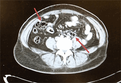 Figure 3. Malrotation of the sigmoid colon and cecum