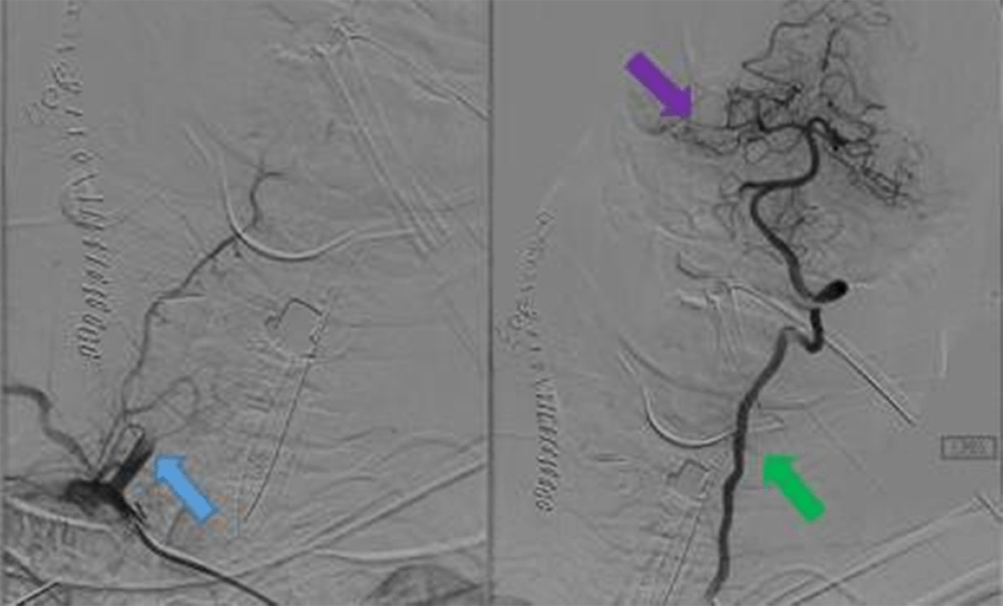 Right VA angiogram with proximal cut-off and subsequent embolization (blue arrow). Left VA angiogram without injury (green arrow) and intact circle of Willis (purple arrow).