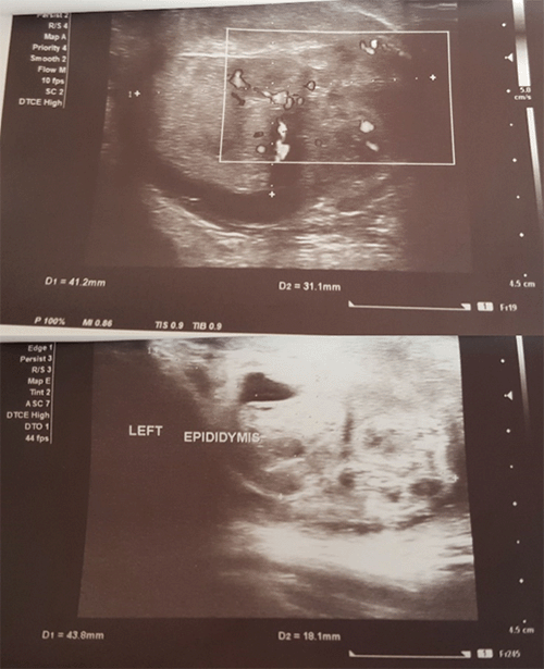 Scans show heterogenous area at posterior part of testes measuring 41.2 × 31.1 mm with vascularity within it with minimal fluid in testicular sac and epididymal head measuring 43.8 × 18.1 mm with vascularity with thickened scrotal wall.