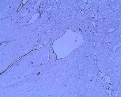 B) Immunostaining Profile, Demonstrating Endometriosis: ER