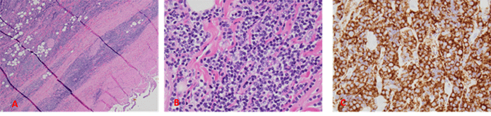 A (H&E stain, 40x): Transmural infiltration of atypical lymphocytes with mixed morphology (small, intermediate, large size) and round to irregular nuclei with condensed chromatin. B (H&E stain, 400x): Higher magnification view of atypical lymphocytes. C (CD20 immunostain): Positive staining for CD20 highlights B-cell lineage of the atypical lymphocytes
