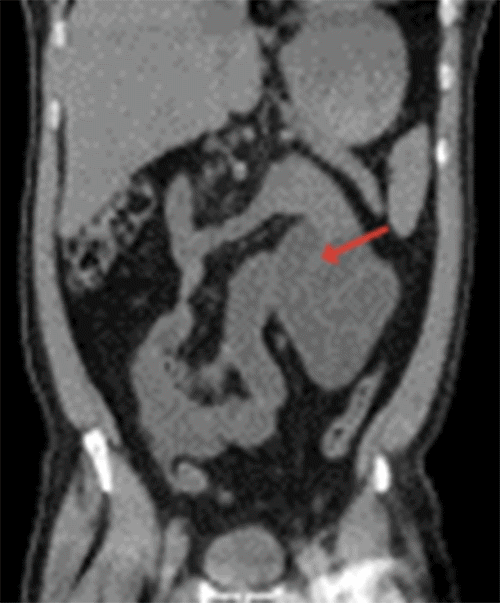 A) Distended and clustered small bowel loops in left upper (arrow). 