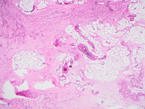 D) 20x: Bland-appearing spindle cells in background of ropey collagen