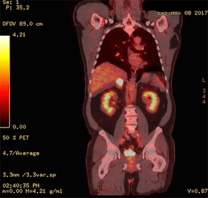 Figure 1. FDG PET demonstrating a hypermetabolic mass in the right adrenal gland