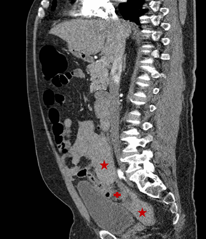 Figure 1. Figure 1a-b. CT demonstrating hemoperitoneum (arrow) and large clot (*) abutting the sigmoid colon (+).