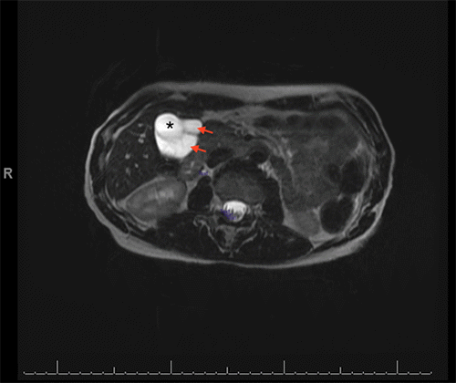 Cystic mass with well-defined margins (red arrows) located posteromedial to the gallbladder (*). Septations identified on ultrasound are less conspicuous but still visible on MRI (within the red arrows).