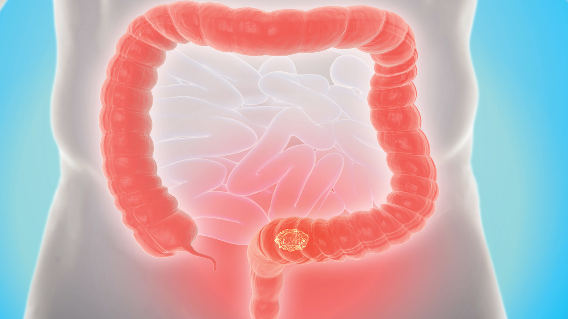 Clinicians Struggle to Understand Dramatic Rise in Early Onset Colorectal Cancer