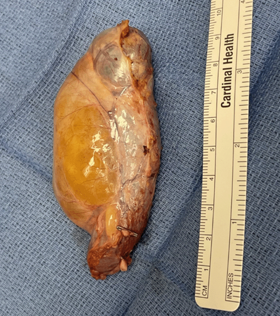 The cystic artery and duct are clipped and visualized at the inferior aspect of the gallbladder (arrow).
