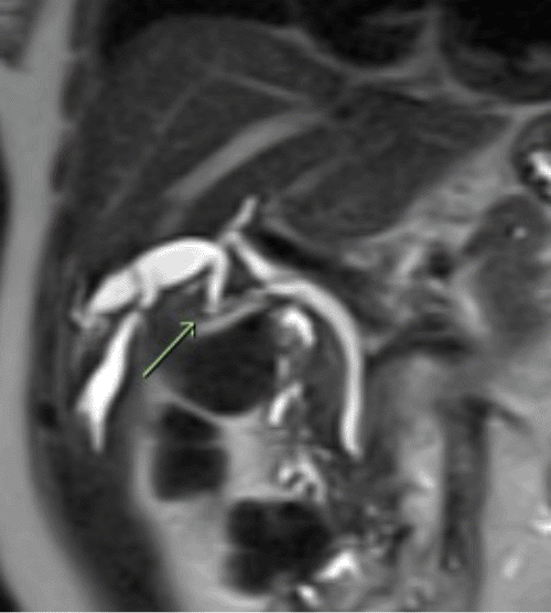 B) MRCP demonstrates dilated intrahepatic ducts draining segments 4B and 5 (IH 4B/5) into the remnant of the cystic duct (R-CD) following cholecystectomy.