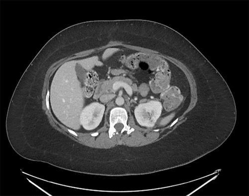 Abdominal viscera have returned to normal position. No evidence of tumor recurrence