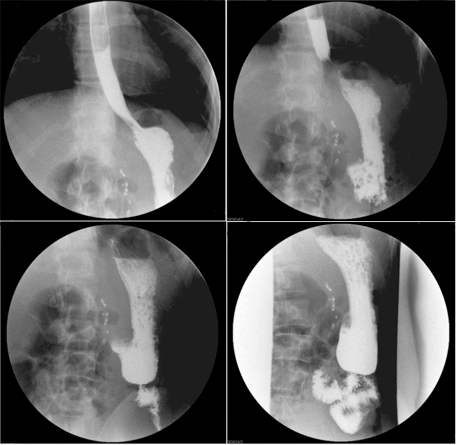 Water-soluble iodinated contrast shows normal contrast transit into proximal jejunum without evidence of obstruction or extraluminal extravasation. Images taken within two-minute period.