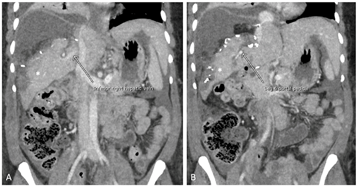 (A) Coronal view showing the inferior right hepatic vein (white arrow) and the preserved segment 6 (white asterisk). (B) Coronal view demonstrating the portal pedicle to the preserved segment 6 (white arrow) and the segment itself (white asterisk)