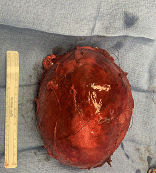 B) right adrenal mass after surgical removal