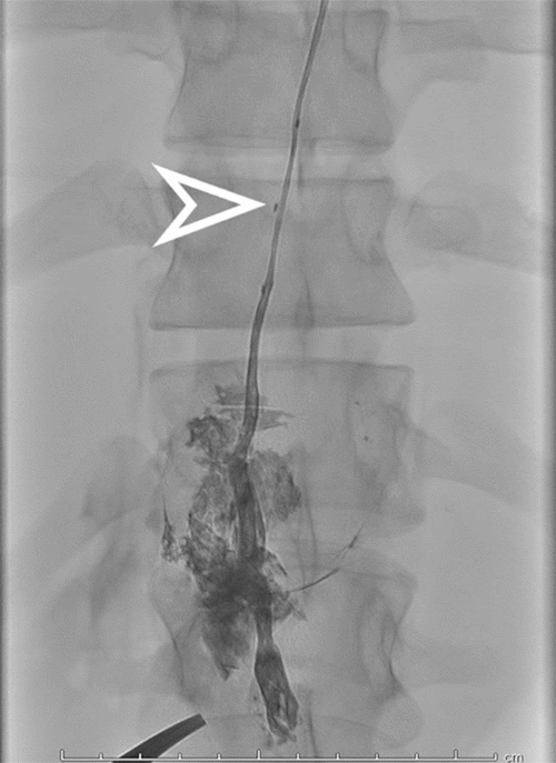 The arrow indicates the placement of the catheter within the thoracic duct. Extravasation of contrast is noted at the puncture site in the cisterna chyli