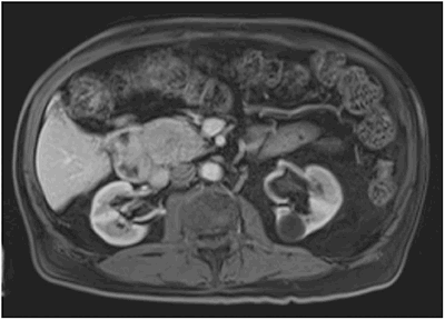Figure 1: MRI showing 5.4 x 3.8 cm hyperintense mass in the uncinate process of the pancreas without evidence of metastatic disease.