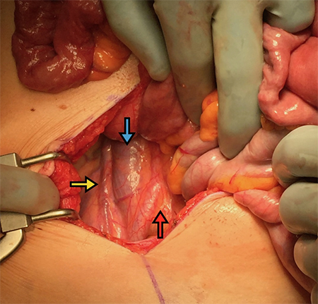 Figure 4. The right ureter and major retroperitoneal vascular structures- aortic bifurcation (red arrow), IVC (blue arrow), and ureter (yellow arrow)- exposed by simple shifting of the small bowel- an obviously abnormal finding which is classic for malrotation.