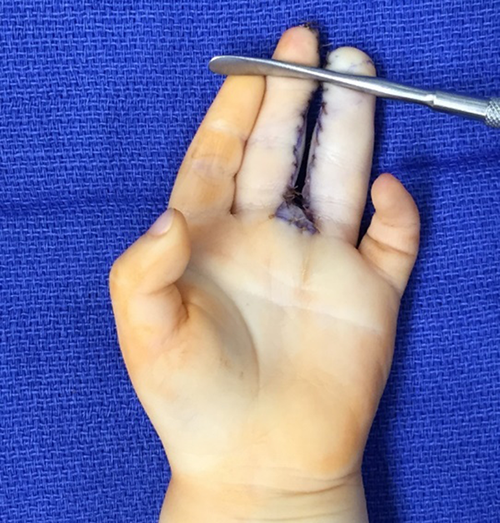 Figure 3. Immediate postoperative picture volar hand.