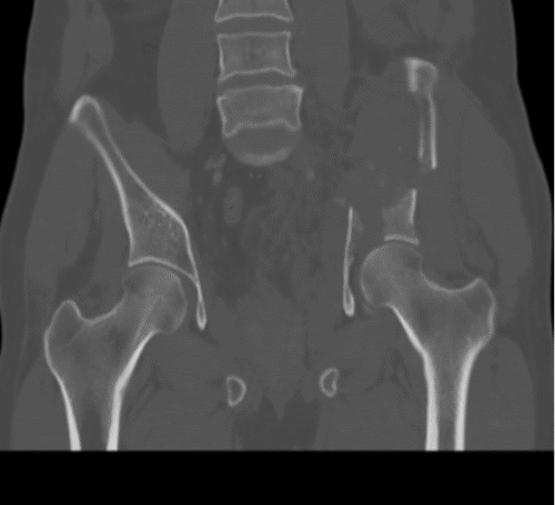 C) Coronal View