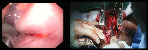 Figure 5. Intraoperative image showing dissection of the inferior aspect of the diverticulum. The view on the left is through the endoscope which is inserted into the diverticulum, showing the indentation of the wall of the diverticulum from external compression. The view on the right shows the inferior portion of the diverticulum being dissected away from the esophagus.