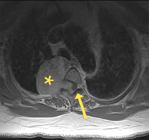 B. Patient subsequently developed neurologic sequelae and was sent for repeat axial T2-weighted image, which demonstrates interval increase in the size of the mass (asterisk), which now extends into the spinal canal and causes mass effect on the cord (arrow).