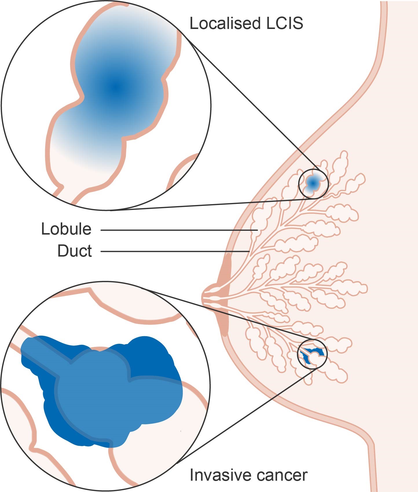 Image Credit: Diagram showing lobular carcinoma in situ (LCIS) CRUK 166 by Cancer Research UK, is licensed under CC BY-SA 4.0, via Wikimedia Commons