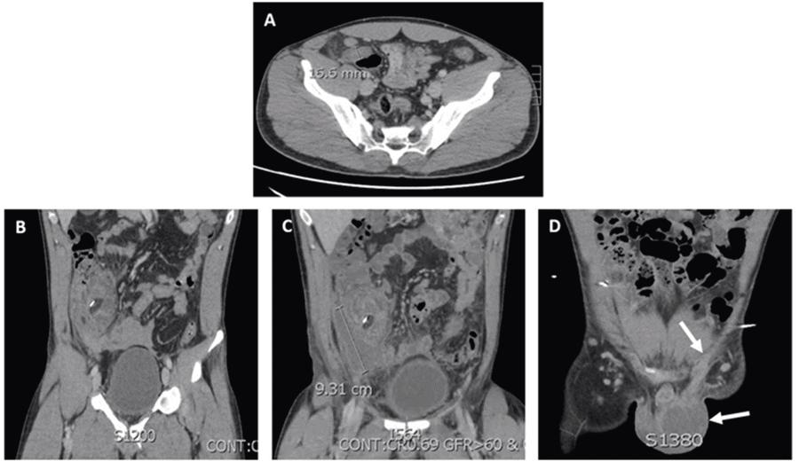 A) CT on initial admission for appendicitis showing dilated appendix to 16.6 mm with surrounding fat stranding and associated 1.1 cm appendicolith at appendiceal base; B) CT on POD5 demonstrating phlegmonous changes in right lower quadrant; (C) CT on POD 9 showing 4.9 × 3.0 × 9.3 cm rim-enhancing right lower abdominal quadrant abscess; and D) CT on POD 18 showing left scrotal abscess (bottom arrow) and enhancement of left spermatic cord (top arrow).