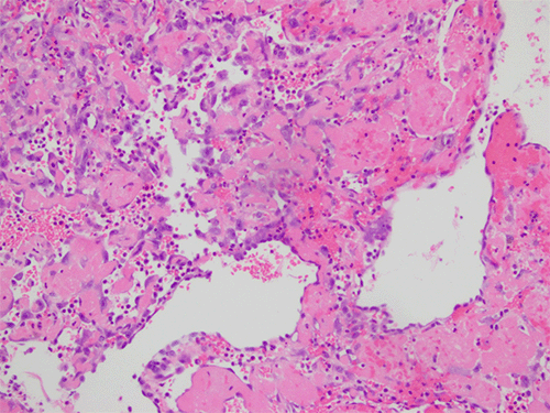 Note atypical endothelial cells having epithelioid morphology, with copious amphophilic cytoplasm and vesicular nuclei