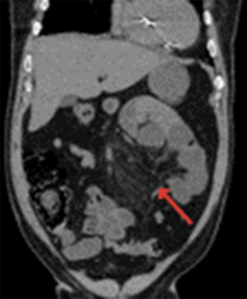 B) Crowding, congestion, and stretching of small bowel mesentery (arrow)
