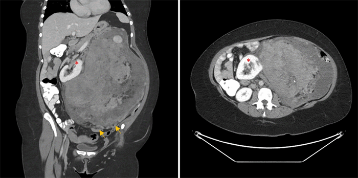 Large, complex left retroperitoneal mass with predominant solid components, peripheral cystic lesions, and interspersed foci of macroscopic fat and calcifications, demonstrating heterogeneous enhancement, displacement of the left kidney (*), and prominent peripheral vessels (arrows)