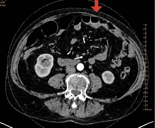Left rectus abdominal musculature smaller than right consistent with left pedicled transverse rectus abdominis muscle (TRAM) flap surgery. No anterior abdominal wall hernia or mass
