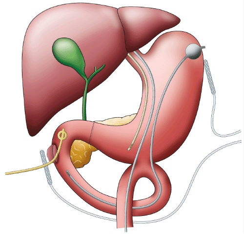 Surgical interventions include pyloric exclusion with gastrojejunostomy. The following tubes and drains were placed: nasogastric tube (gastric decompression); nasojejunal tube (post-anastomotic feeding); gastrojejunostomy tube (retrograde drainage); Malecot drain (perforation cavity into duodenum); and Jackson-Pratt drains (perforation cavity, left upper quadrant, and pelvis [not shown])