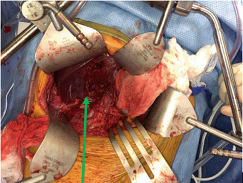 A) Exposed right adrenal tumor intraoperatively