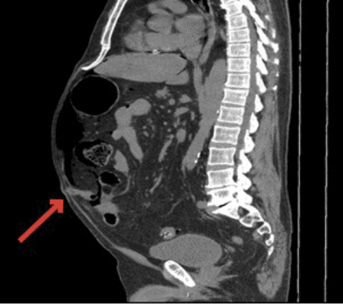 B) sagittal view with Meckel’s diverticulum present in umbilical hernia (arrow)