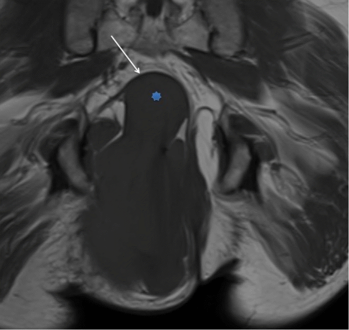The large pelvic neurofibroma (asterisk) distorts and displaces the levator ani muscle (white arrow)