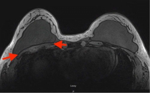 Scan at five months post-cryoablation demonstrates further involution to 8.5 × 7.8 × 1.3 cm