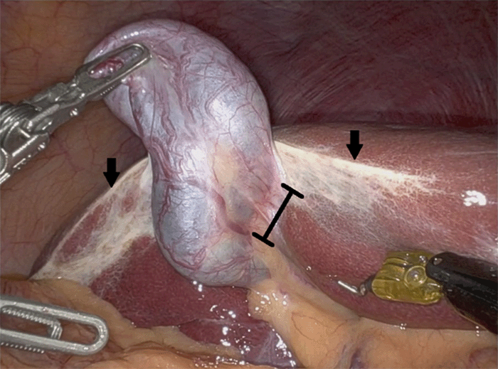 The gallbladder, grasped inferolaterally by robotic laparoscopic instruments, is shown. The black line demarcates the approximate area of attachment between the gallbladder neck and the gallbladder fossa of the liver, demonstrating its relatively small size compared to the overall gallbladder length. Black arrows indicate fibrosis along the inferior liver margin, consistent with mechanical trauma from the freely mobile gallbladder.