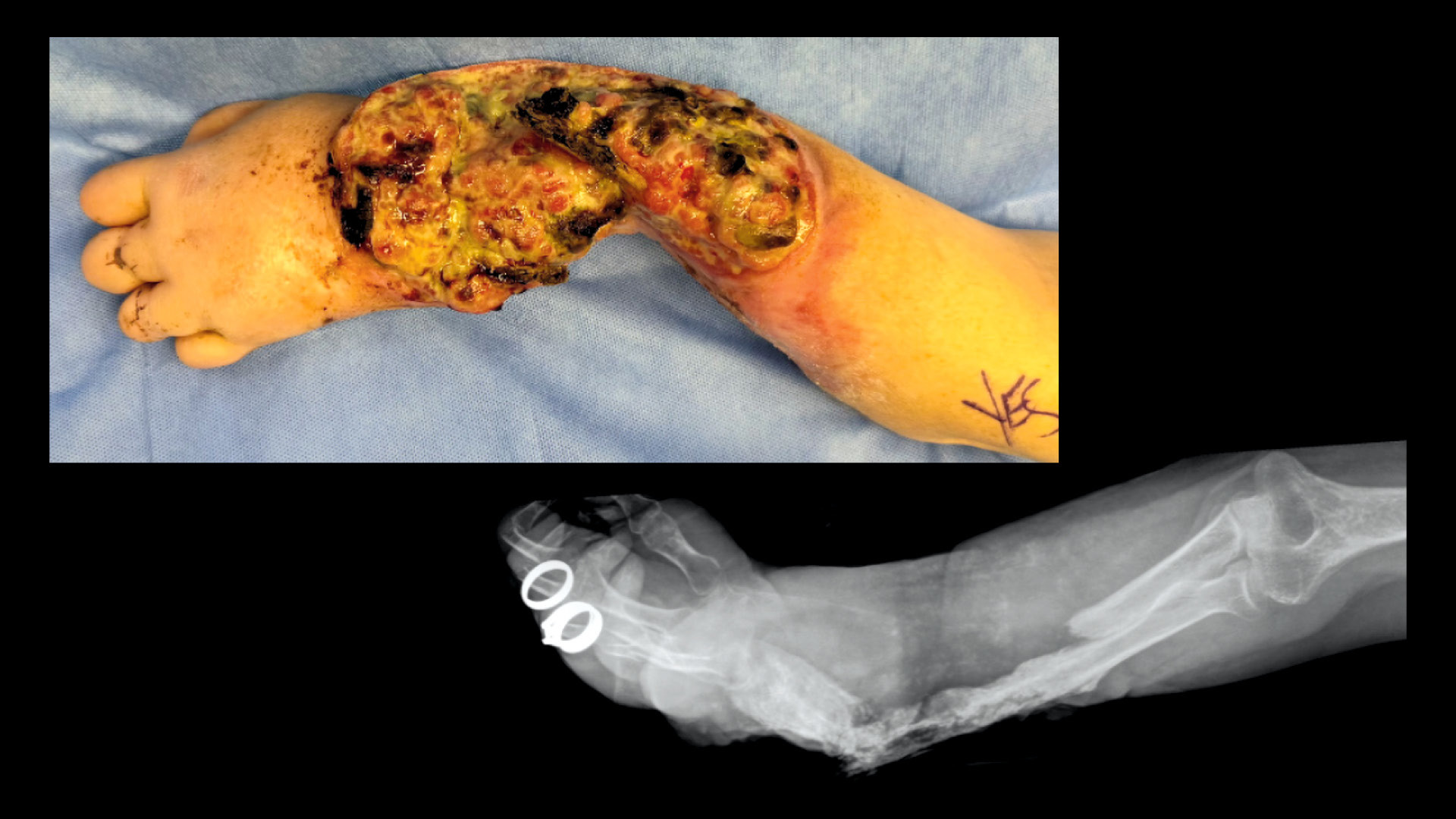 Surgeons Handle New and Alarming Pathology—Xylazine Wounds
