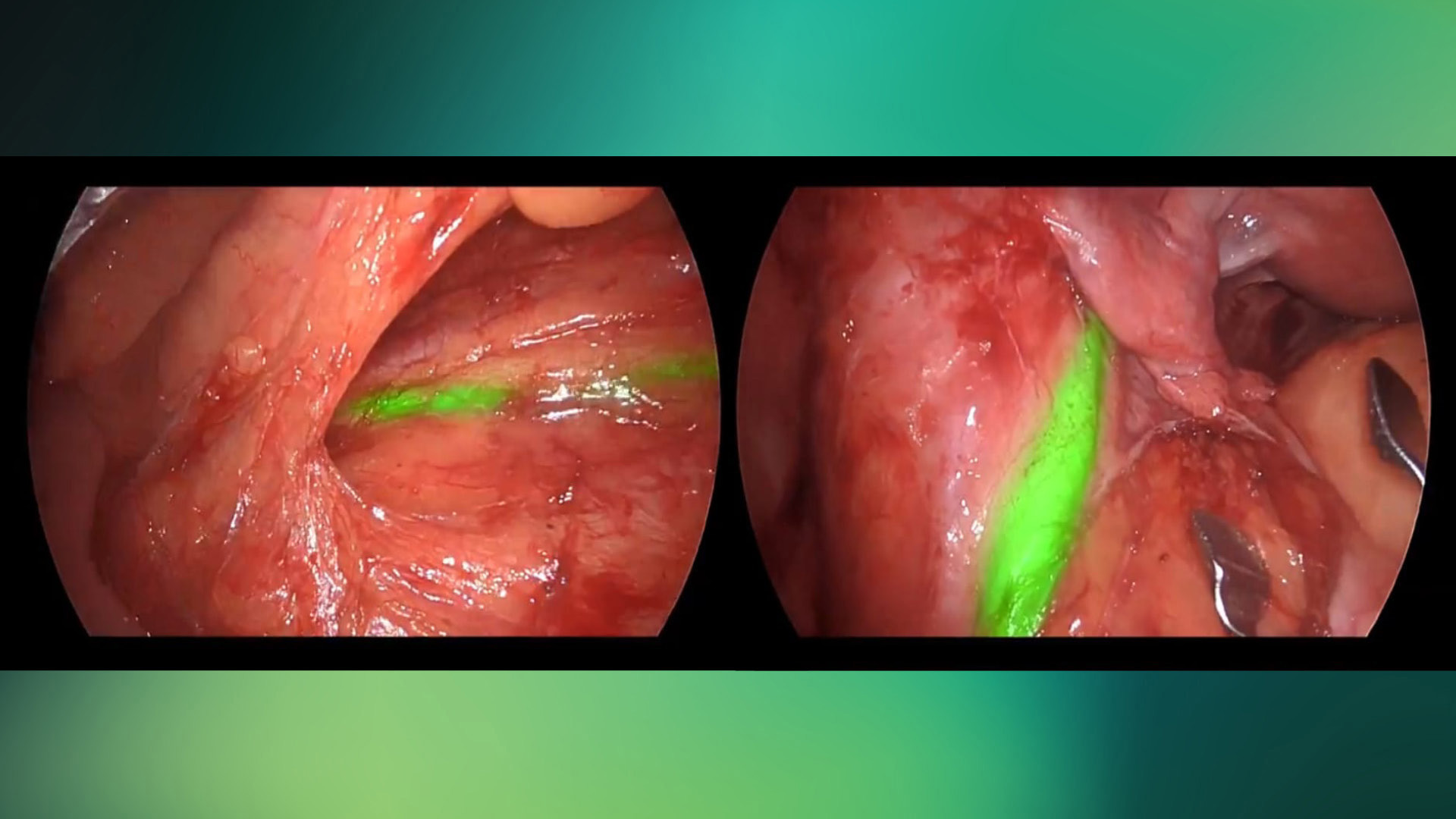 Fluorescence-Guided Surgery May Soon Extend Beyond Oncology