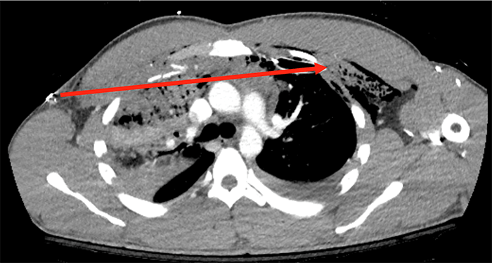 Figure 3. Axial CT image of patient with Transmediastinal gunshot wound depicting the bullet trajectory. Solid red line depicts bullet trajectory based on tissue injury on CT scan.