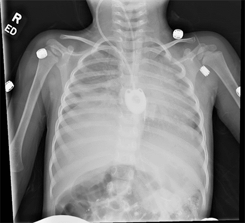 Arrow denotes location of catheter tip at procedure’s end, which appears to be more medial than its usual location
