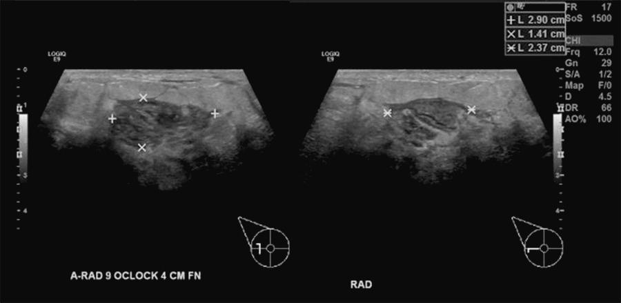 Right breast ultrasound showing a heterogeneous hypoechoic region measuring 2.9 cm within right lateral breast at 8 to 9 o’clock position approximately 4 cm from nipple. Note surrounding edematous tissue and hyperemia concerning for breast abscess.