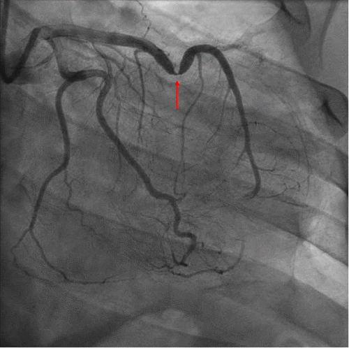 Note severe stenosis in the apical segment of the LAD artery (arrow). The occluded diagonal branch is poorly visualized in this projection.