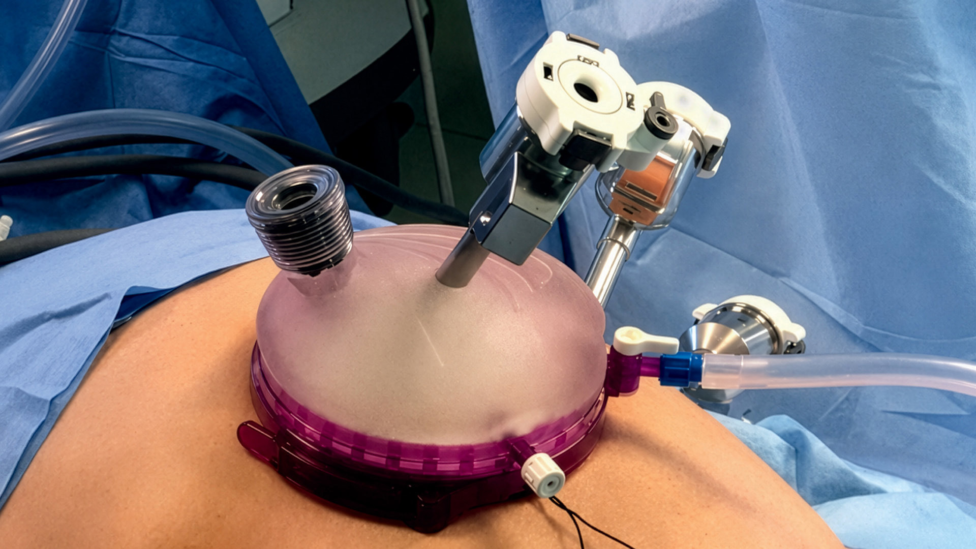 Robotic Kidney Transplant Is Expanding Alongside Growing Evidence